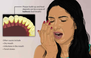 구취를 유발하는 요소를 나역하고 있는 그림