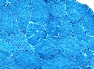 근육에서 드러나는 당원병의 흔적